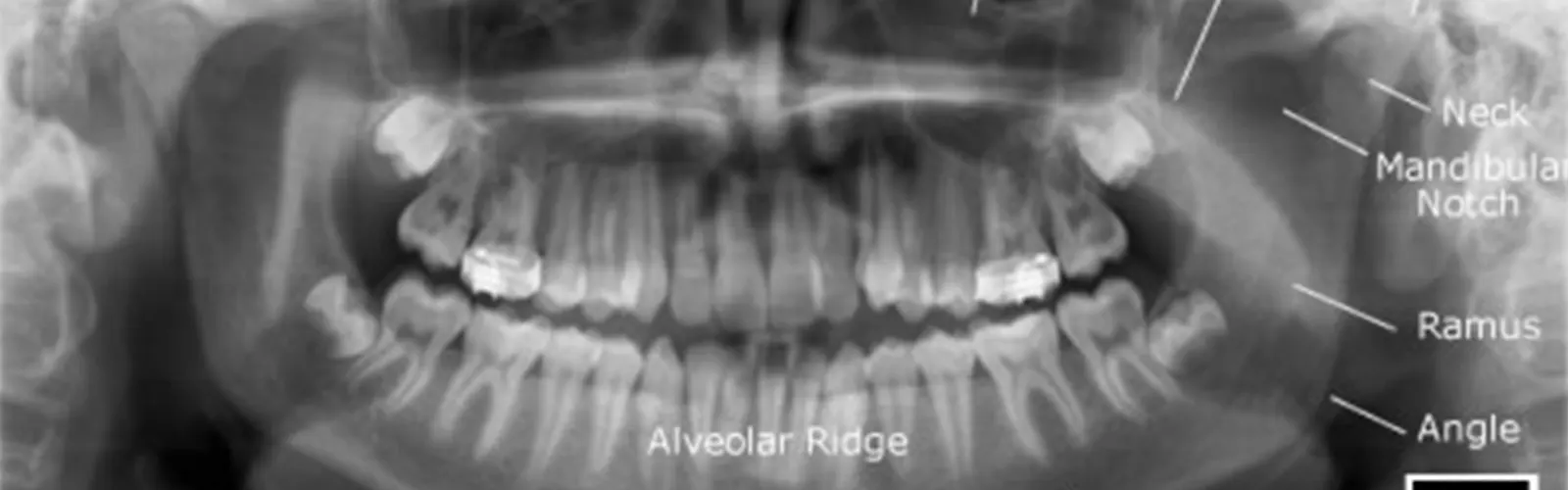 What are the Indications of OPG Scan?